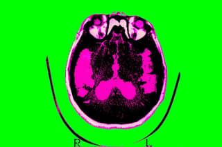 Alzheimer’s research gains momentum with new drug approvals and broader targets