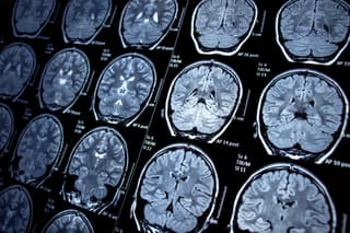 Lymph Node Signals Drive Alzheimer’s Brain Damage, Study Finds