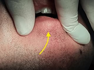 Rare Lower Lip Tumor Misdiagnosed as Cyst Highlights Diagnostic Pitfalls