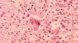 Pennsylvania Measles Outbreak Reaches New Milestone with Birth Infections and Federal Data Dispute