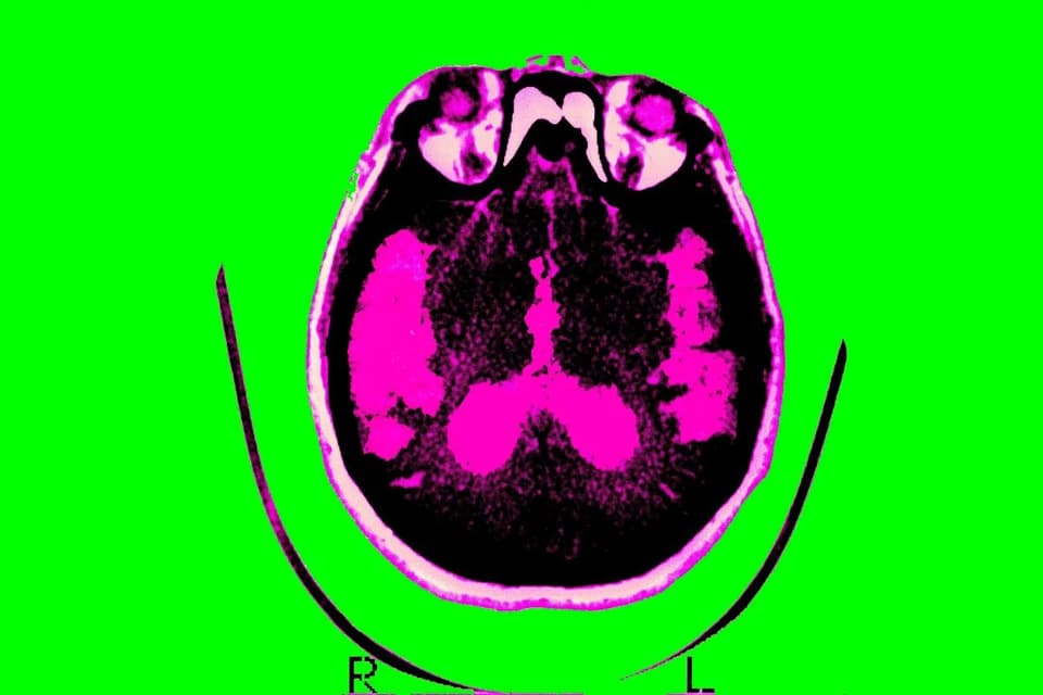 Alzheimer’s research gains momentum with new drug approvals and broader targets