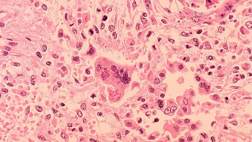 Pennsylvania Measles Outbreak Reaches New Milestone with Birth Infections and Federal Data Dispute