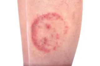 Global Spread of Antifungal-Resistant Ringworm Strain Prompts Health Alarm