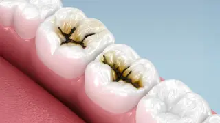 Brush-on liquid stops cavities in kids without drilling, study finds