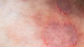 Global Rise of Drug-Resistant Ringworm Fungus Sparks Health Alert