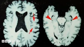 New study ties high CTE risk to former NFL players, urges safer head-impact limits