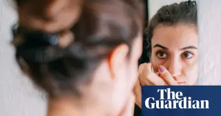 Experts debate 'ferritin face' trend: visual clues vs. medical reality