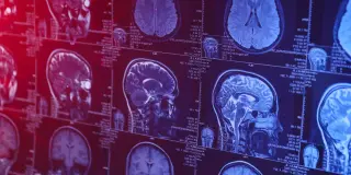 Smartphone Overuse Linked to Gray-Matter Reduction and Brain Connectivity Shifts