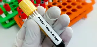 Overdiagnosis Rises Sharply After 70 in PSA Prostate Screening, Study Finds