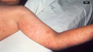 First measles case confirmed in Butler County as health officials warn of regional outbreak