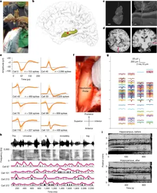 Hippocampus Under Anesthesia Reveals Language Processing and Rapid Plasticity