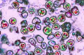 Measles infection causes 'immune amnesia,' erasing up to 73% of immune memory