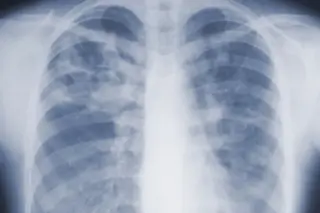 Two-Minute CT Scan Saved a Life After Decades of Smoking