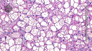 Study Links Active Brown Fat to Reduced Risk of Diabetes and Depression