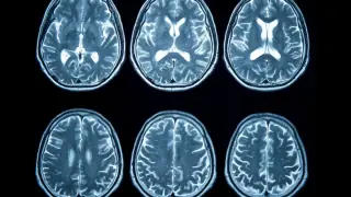 Young Adult Stroke Rates Double in Three Decades, Study Finds