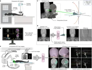 New AI tool aligns 3D scans with X-rays in seconds for surgery