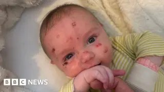 Parent of child with rare 'butterfly skin' disorder demands UK government increase research funding