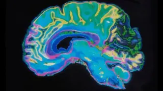 Menopause May Temporarily Slow the Brain's Aging, Scans Show