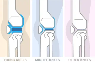 New research suggests knees are more resilient than previously believed, with activity key to long-term health