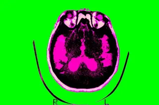 Alzheimer’s research gains momentum with new drug approvals and broader targets