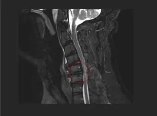 Guillain-Barré Syndrome Unmasked in a Patient with Cervical Myelopathy and Lumbar Stenosis After a Fall