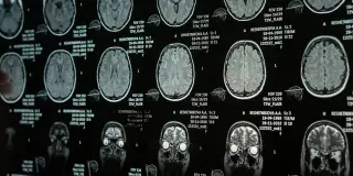 Anterior insula ties narcissistic traits to emotional suppression, study shows