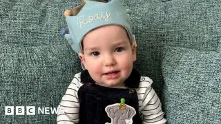 Groundbreaking nitinol-spring surgery reshapes baby’s skull in rare craniosynostosis case