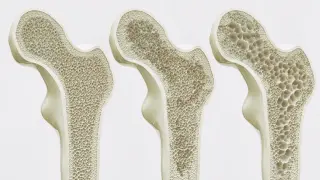 Large review finds calcium and vitamin D offer little protection against fractures