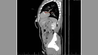 Heart Needle Case: Self-Inserted Foreign Bodies Found in a Man with Intellectual Disability