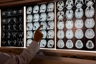 Frontotemporal Dementia Often Begins in Midlife, with Subtle Early Clues