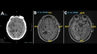 Tapeworm in the Brain Mistaken for Cancer, Case Reveals