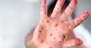 Measles Outbreak Not Linked to Illegal Immigration, Experts Say