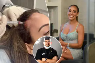 Melissa Gorga Uses PRP and Exosome Injections to Reverse Hairline Thinning