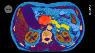 Breakthrough drug targets ‘undruggable’ cancer, doubles survival in pancreatic cancer