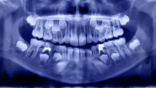Baby Teeth Reveal Chronic Chemical Exposure in Children with Autism
