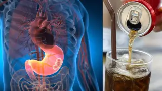 New Study Links Daily Sugary Drinks to 2.5x Stomach Cancer Risk