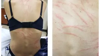 Whip-marked rash after shiitake mushrooms reveals a rare dermatitis case