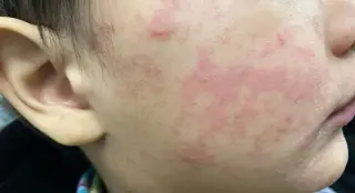 Amtrak-linked measles case triggers KC-area exposure net and vaccination push