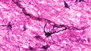 Stem-Cell Immune Reset Sparks Long-Term Remission in Two NMO Patients