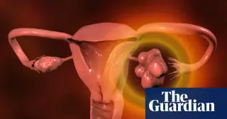 UK Guidelines Push Early PMOS Checks for Women with Irregular Periods