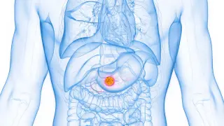 Olive-Oil Fat May Fuel Pancreatic Cancer, AI and Therapies Offer New Hope