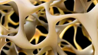 Personal Stem Cells Show Promise in Reversing Osteoporosis in a Small Trial