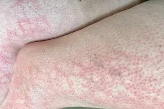 Rising toasted skin syndrome seen in children from extended device use