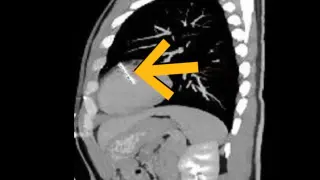 36-mm needle in the heart prompts rare surgical rescue in self-embedding case