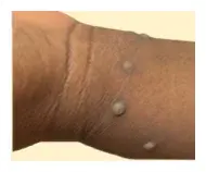 San Diego County Reports Clade I Mpox Case