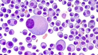 FDA approves Zenbexus, first-in-class therapy for advanced multiple myeloma