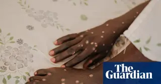 Mpox reemerges in Guinea-Bissau as outbreaks reach new shores