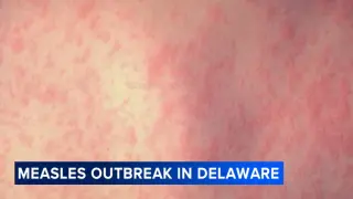 Measles outbreak declared in Delaware as cases rise in Chester County, PA