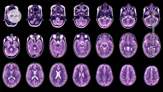 Cortical Thinning Timelines Predict Adolescent Mental Health Risks