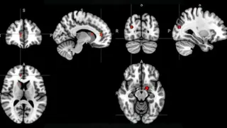 Acupuncture May Rewire Depression Brain Circuits, New Imaging Sheds Light